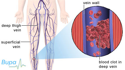 A blood clot in the deep vein of the calf which causes deep vein thrombosis