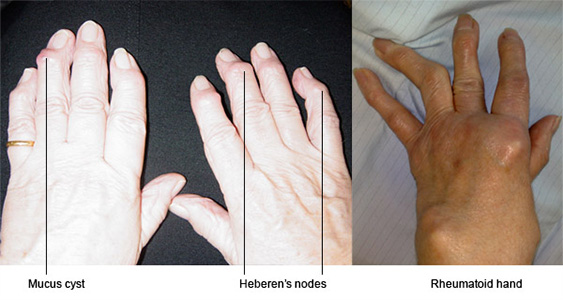 kéz lornet reumatoid artritisz