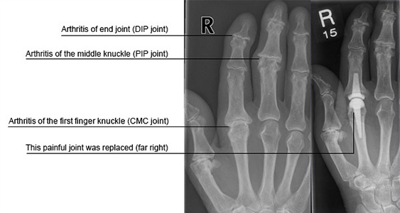 Arthritis of the hand