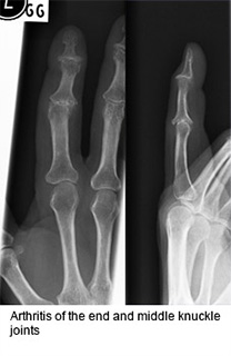 Arthritis of the hand