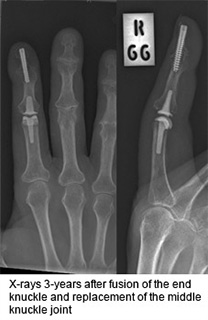 Arthritis of the hand