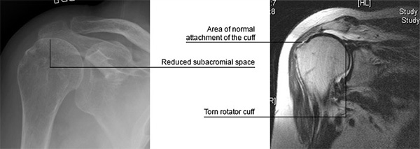 Rotator Cuff Problems & Tears