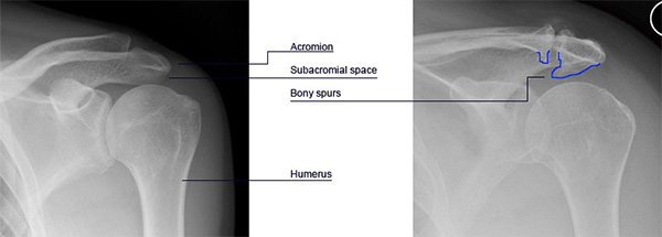 Impingement Syndrome