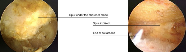 Impingement Syndrome