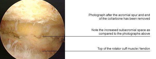 Impingement Syndrome