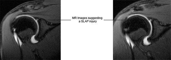 SLAP Injury