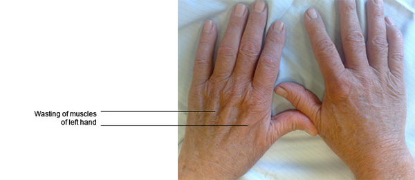 Ulnar Neuritis (Cubital tunnel syndrome)